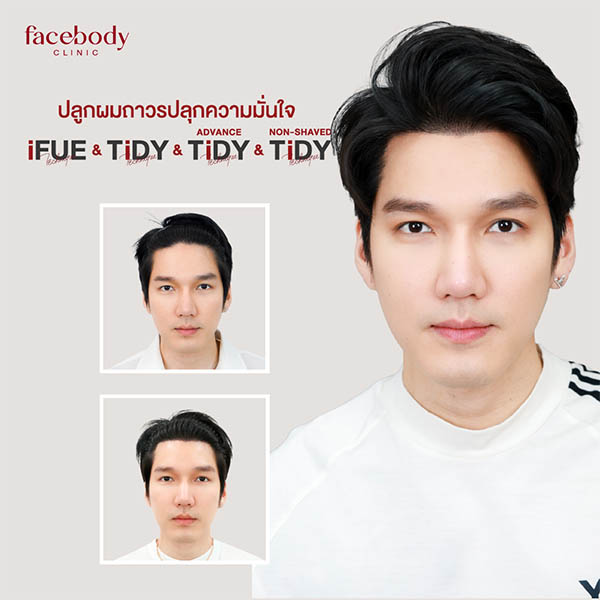 รีวิวปลูกผม Facebody Clinic ผลลัพธ์ก่อน-หลัง