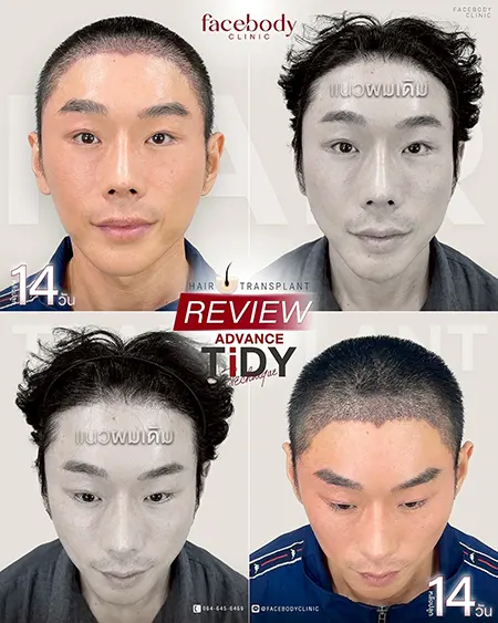 ปลูกผมเทคนิค ADVANCE TiDY รีวิว 14 วัน Facebody Clinic