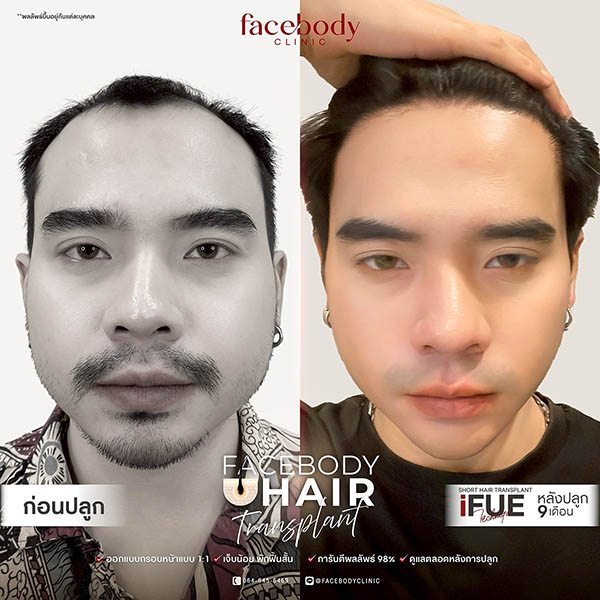 ปลูกผมเทคนิค iFUE ก่อน-หลัง 9 เดือน Facebody Clinic