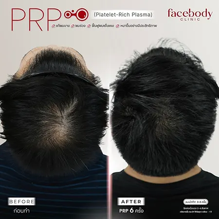 PRP Platelet-Rich Plasma แก้ผมร่วง ผมบาง ก่อน-หลัง 6 ครั้ง Facebody Clinic