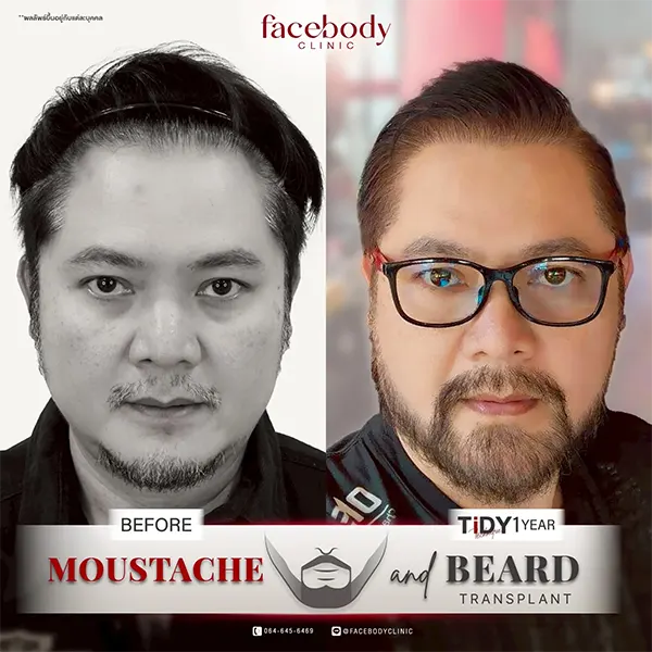 ปลูกหนวด เครา ปลูกผมเทคนิค TiDY ก่อน-หลัง 1 ปี Facebody Clinic